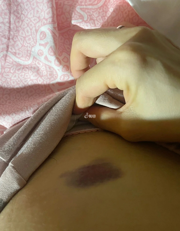 有没有羊水穿刺5天后伤口图片