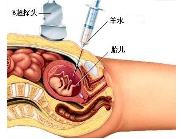 羊水穿刺检查费用较高