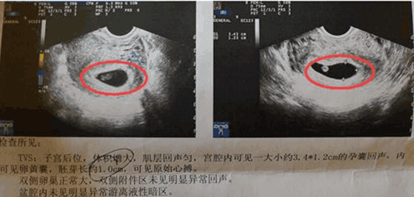 网传的孕囊形状偏长条形就意味着生男孩