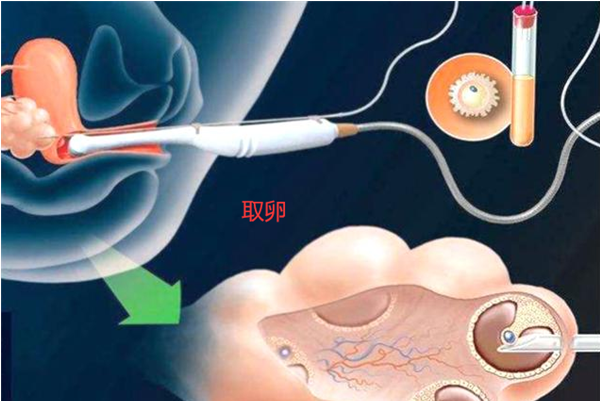取卵手术在5-10分钟左右