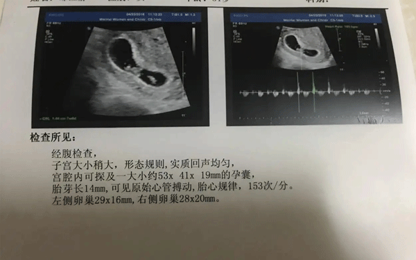 发育较好的孕囊是圆扁形的