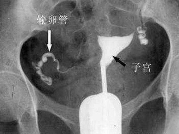 输卵管两侧不通可做试管婴儿