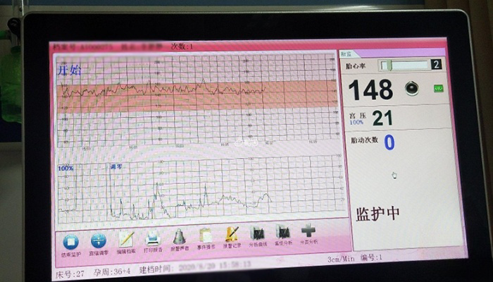 宫缩异常会导致胎心监护不太好