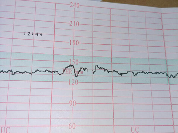 甲状腺低的患者心率会减慢