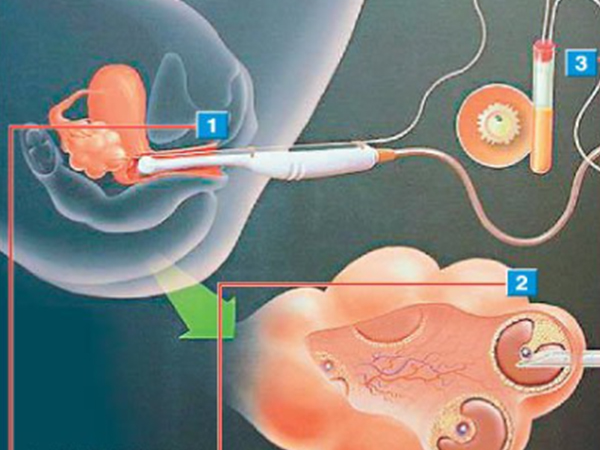 使用双腔取卵可降低了取卵伤害