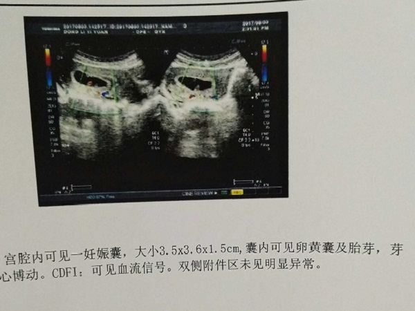 孕囊形状偏长条形是男宝宝的概率大