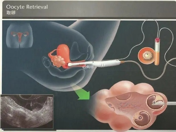 取卵费用在2000元左右