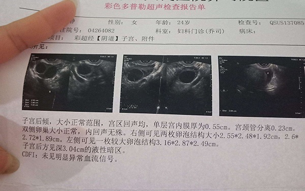 卵泡21x21医生说老有原因