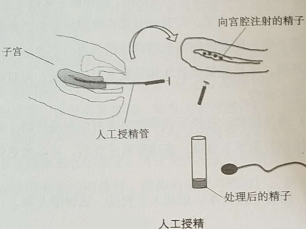 在北京做人工授精可报销费用